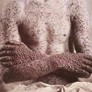 Person with smallpox