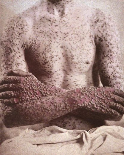 Person with smallpox